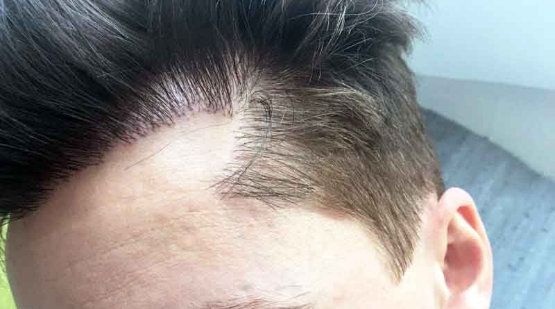 hair transplant